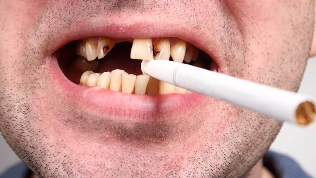 Fumare con impianti dentali? Un pericolo per la vostra salute